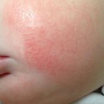 Атопический дерматит у ребёнка