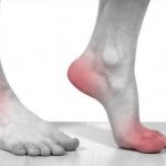 The main symptom of gout is joint pain, but it is not so much a joint disease as a metabolic disease