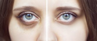 How to remove dark circles under the eyes