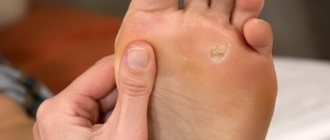 How to remove a thorn on your foot at home?