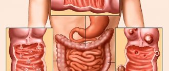 Colitis of the intestines