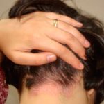 Лечение псориаза на голове: фото, как лечить в домашних условиях