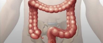 colon treatment symptoms and treatment