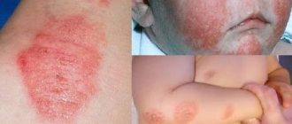 Limited form of neurodermatitis