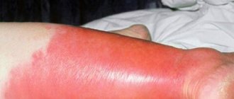 erysipelas skin disease
