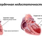 Схема сердечной недостаточности