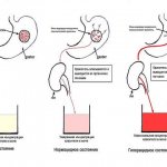 Stomach condition