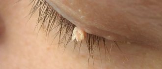 papilloma virus on the eyelid